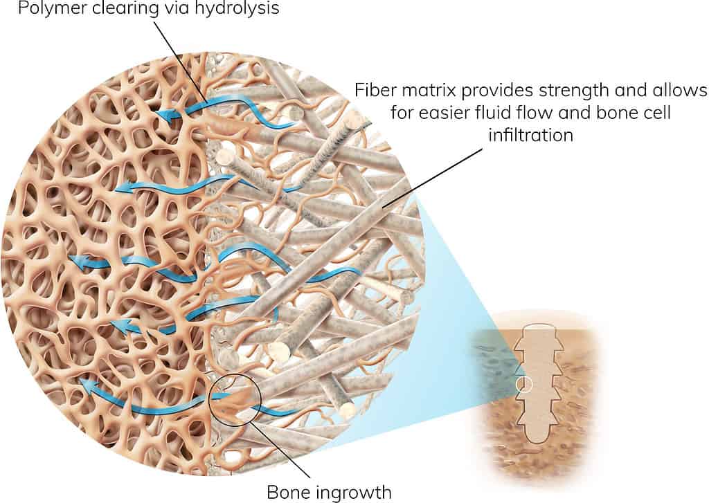 OssioFiber Final Callouts 1 scaled 1 OSSIO – Naturally Transformative Bone Healing