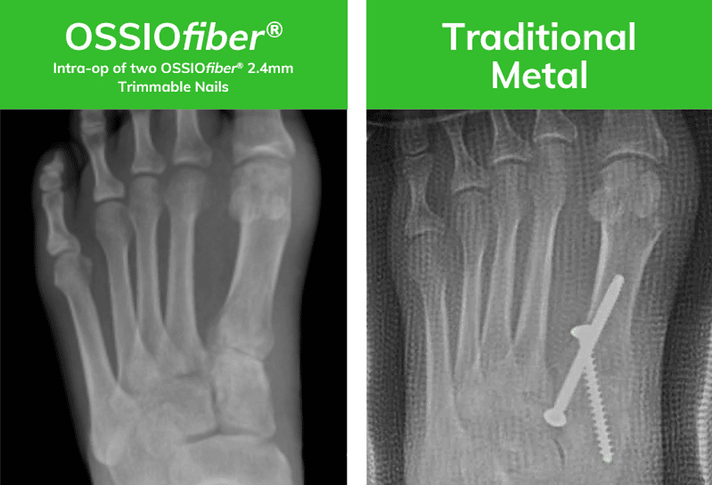 Before After Trimmable Ossio – Naturally Transformative Bone Healing