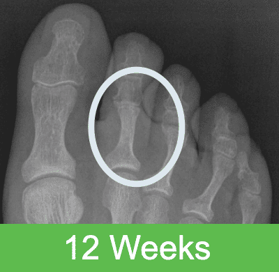 12 weeks OSSIO – Naturally Transformative Bone Healing