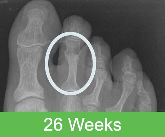 26 Weeks 1 Ossio – Naturally Transformative Bone Healing