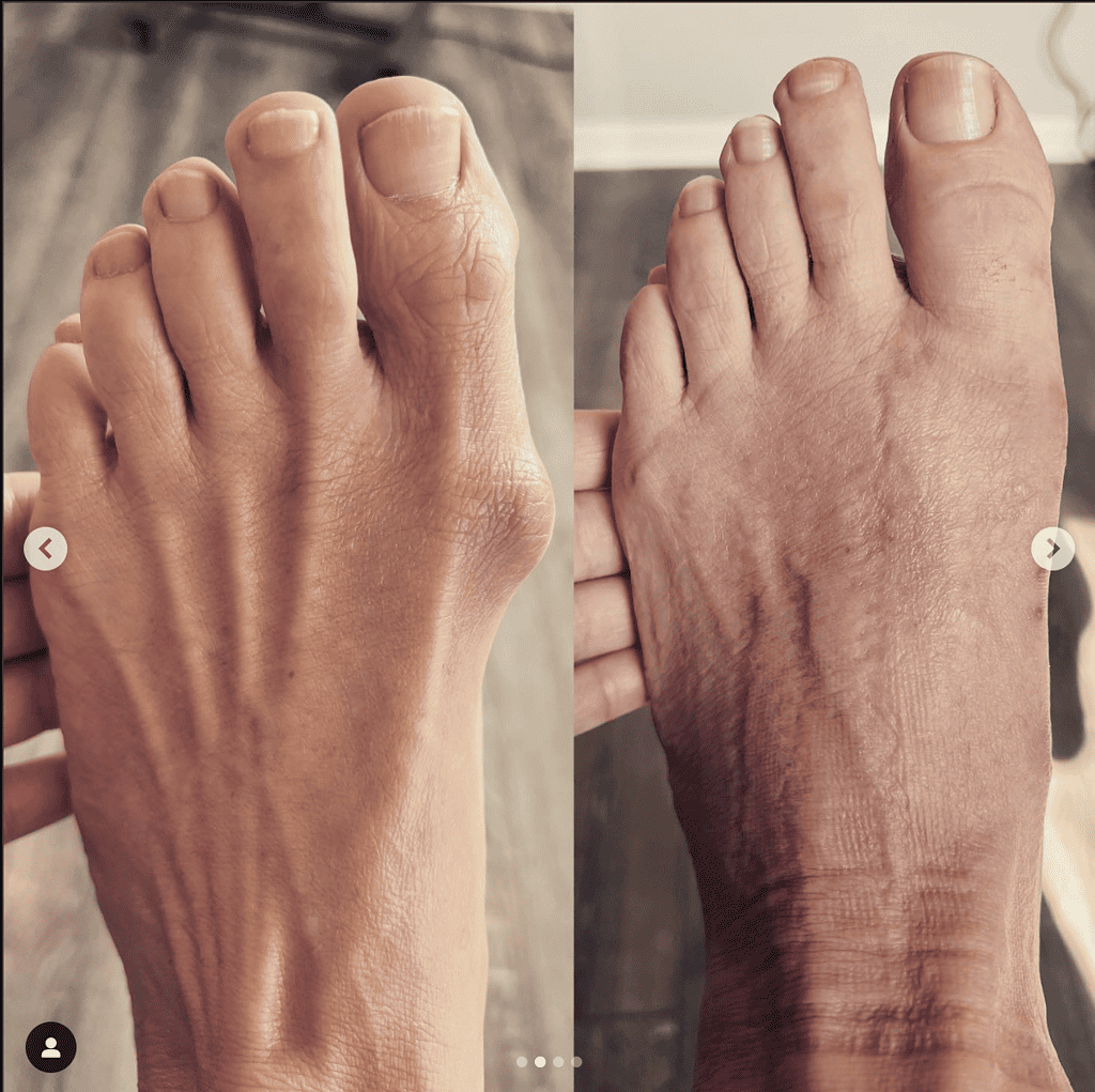 Bunion - Before &Amp; After