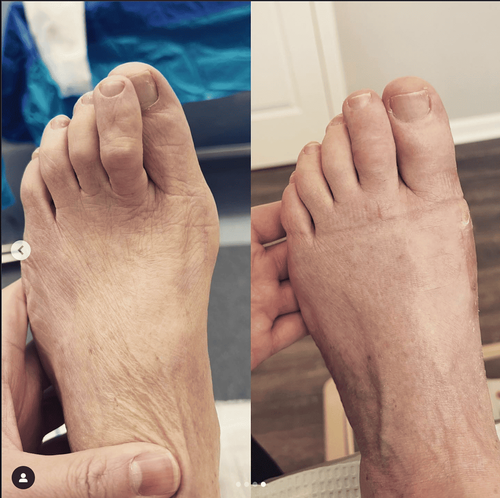 Before And After Ossio – Naturally Transformative Bone Healing