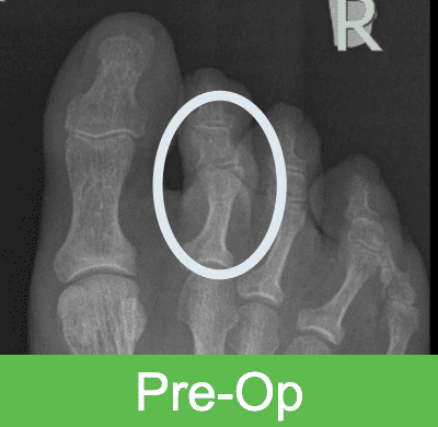 preop OSSIO – Naturally Transformative Bone Healing