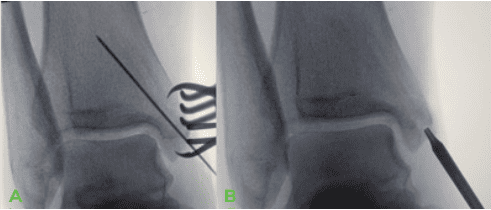 Dr Palmer Medial Malleous Fracture 2 OSSIO – Naturally Transformative Bone Healing