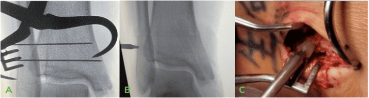 Dr Palmer Medial Malleous Fracture 3 OSSIO – Naturally Transformative Bone Healing