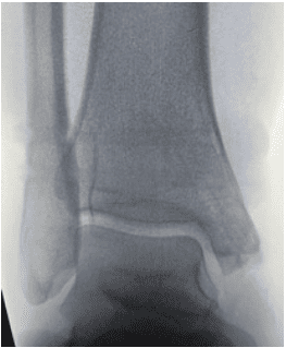 Dr Palmer Medial Malleous Fracture 4 OSSIO – Naturally Transformative Bone Healing
