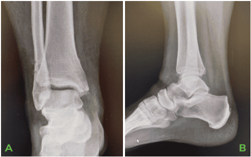 Dr Palmer Medial Malleous Fracture 5 OSSIO – Naturally Transformative Bone Healing