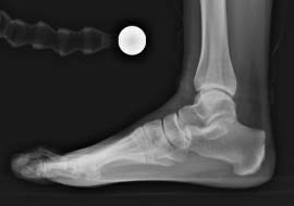 Pre-Op Lateral X-Ray Image