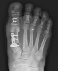 Immediate Post-Op A/P X-Ray With Ossiofiber® Trimmable Nail Trajectory In Green