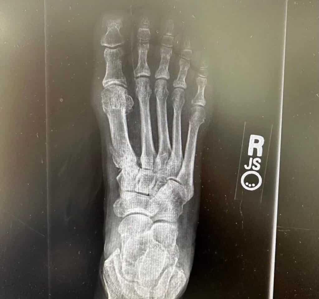 Dr. Bob Baravarian 8 1 After Pic Ossio – Naturally Transformative Bone Healing