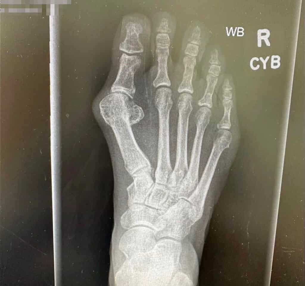 Dr. Bob Baravarian 7 2 Before Pic Ossio – Naturally Transformative Bone Healing