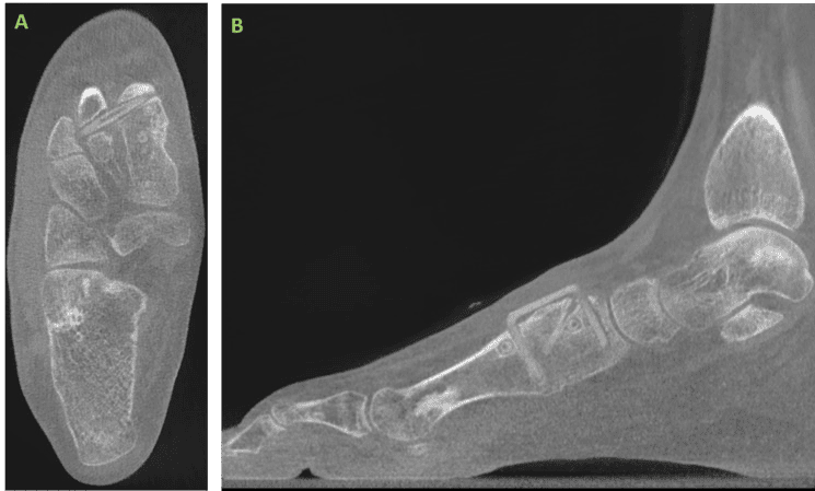 3 Ossio – Naturally Transformative Bone Healing