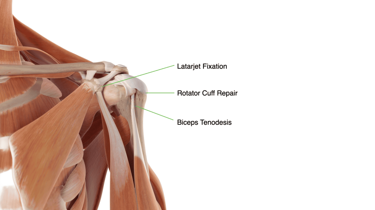 Ossio Sport Shoulder Updated Ossio – Naturally Transformative Bone Healing