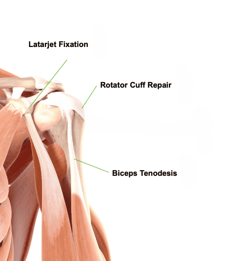 Shoulder Sports Mobile Ossio – Naturally Transformative Bone Healing