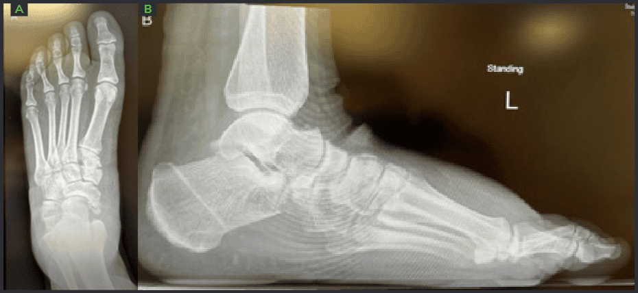 Flatfoot Reconstruction 8 weeks post operative OSSIO – Naturally Transformative Bone Healing