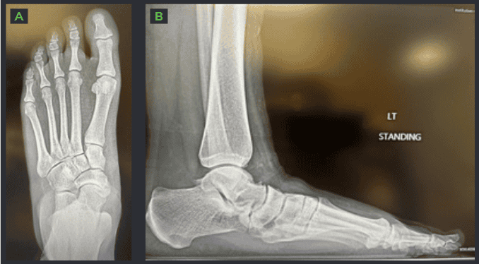 Flatfoot Reconstruction OSSIO – Naturally Transformative Bone Healing
