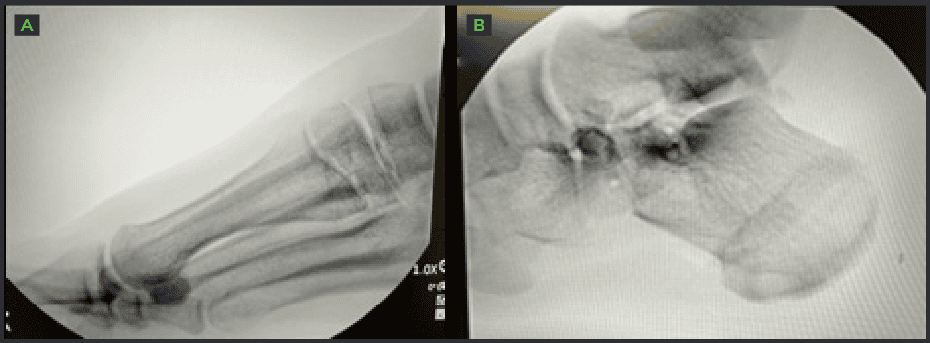 Intra operative Fluoroscopy OSSIO – Naturally Transformative Bone Healing