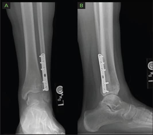 4 Months Post Operative X Rays Ossio – Naturally Transformative Bone Healing