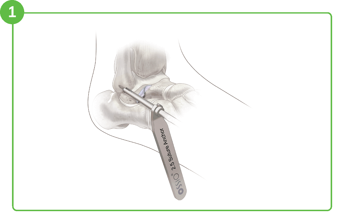 Ossiofiber® 2.5Mm Suture Anchor 13 The Better Brostrom Repair With 2.5 Suture Anchors Ossio – Naturally Transformative Bone Healing