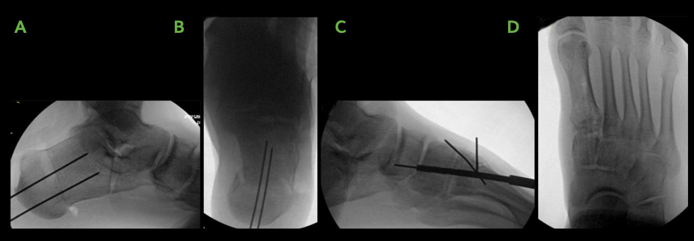 All-Natural Flatfoot Reconstruction 2 Flatfood Procedure Xrays Image Ossio – Naturally Transformative Bone Healing