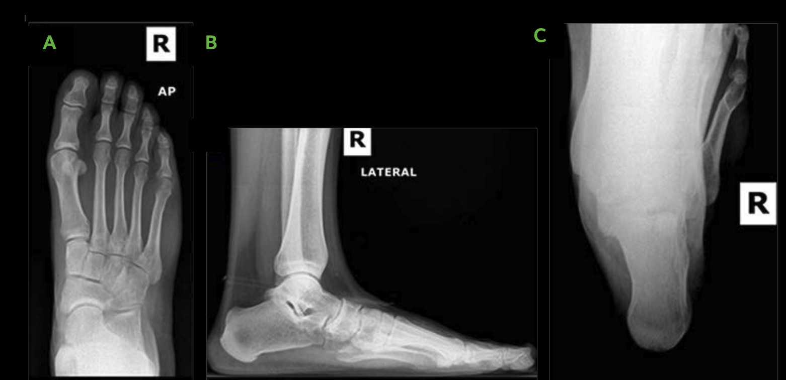 All-Natural Flatfoot Reconstruction 1 Flatfoot Procedure Image Ossio – Naturally Transformative Bone Healing