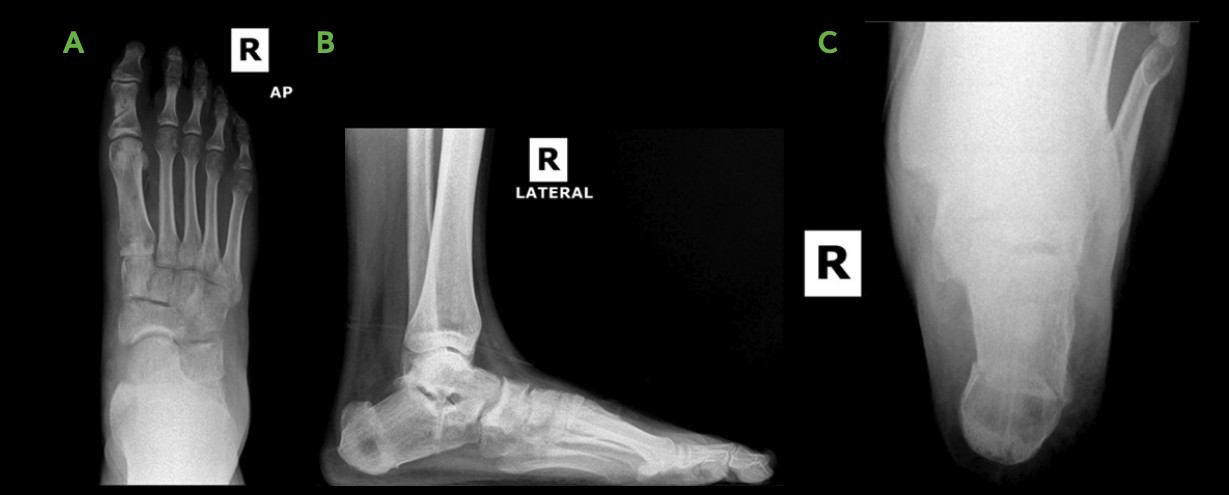 All-Natural Flatfoot Reconstruction 3 Post Op Flatfoot Procedure Image Ossio – Naturally Transformative Bone Healing
