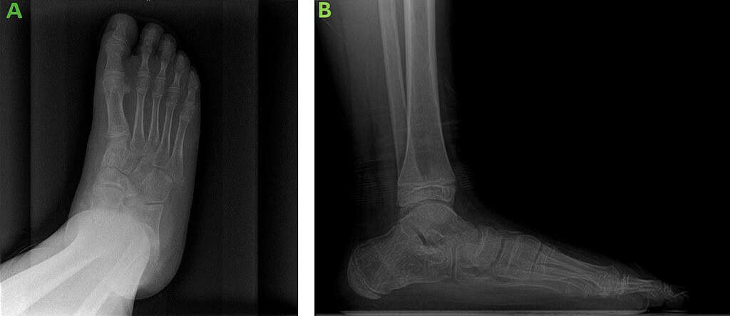 Biointegrative Treatment Of Pediatric Spastic Flatfoot With Diagnosed Coalition 4 14 Weeks Post Op X Ray Ossio – Naturally Transformative Bone Healing