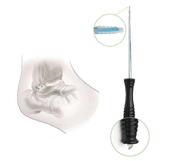 Brostrom Repair 1 Frame 272 Ossio – Naturally Transformative Bone Healing