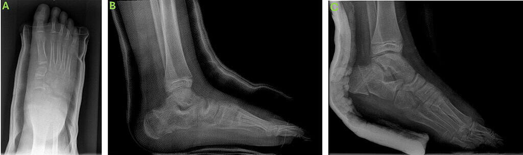 Biointegrative Treatment Of Pediatric Spastic Flatfoot With Diagnosed Coalition 3 First Post Operative X Rays Splint Ossio – Naturally Transformative Bone Healing