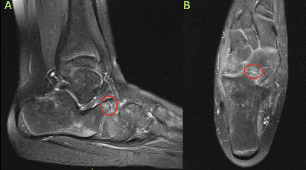 Biointegrative Treatment Of Pediatric Spastic Flatfoot With Diagnosed Coalition 2 Pre Operative Mri Images Ab Ossio – Naturally Transformative Bone Healing