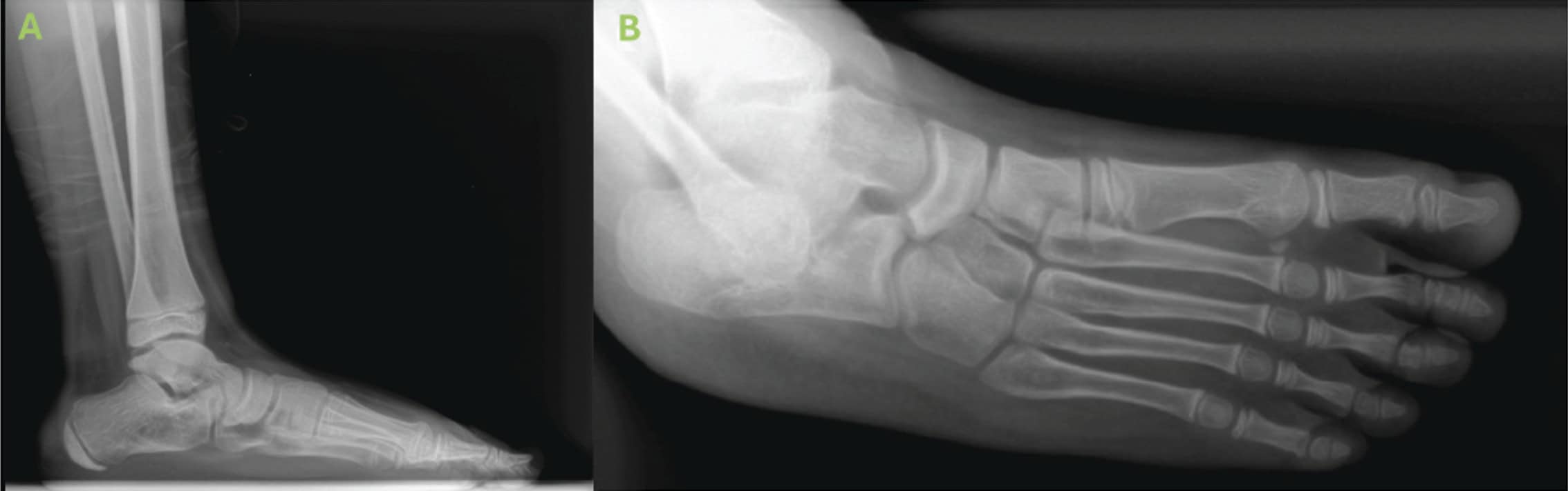 Biointegrative Treatment Of Pediatric Spastic Flatfoot With Diagnosed Coalition 1 Pre Operative X Ray Ab Ossio – Naturally Transformative Bone Healing