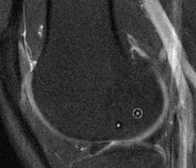Kneebar® Procedure 4 Post-Op Mri