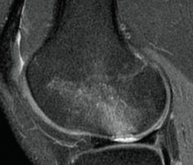 Kneebar® Procedure 3 Pre-Op Mri