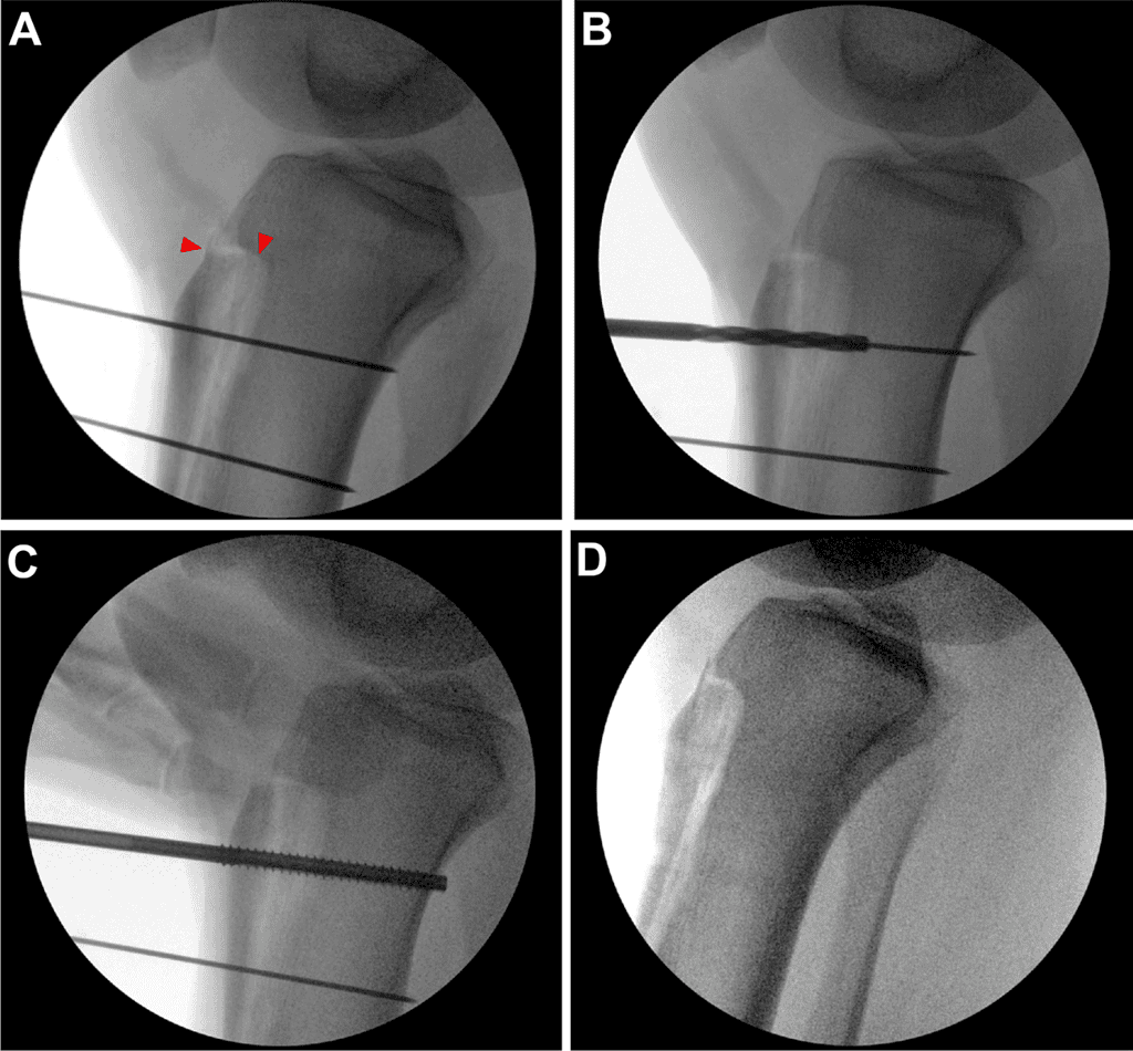 After Tibial Tubercle Osteotomy