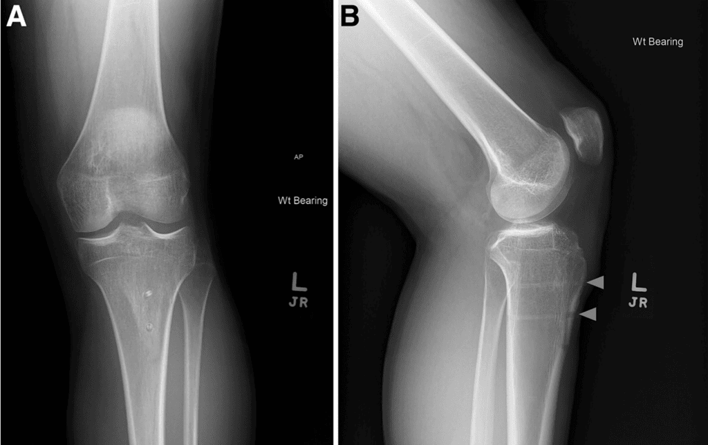 Representative (A) Anteroposterior And (B) Lateral Postoperative Radiographs Of Tibial Tubercle Osteotomy Fixation