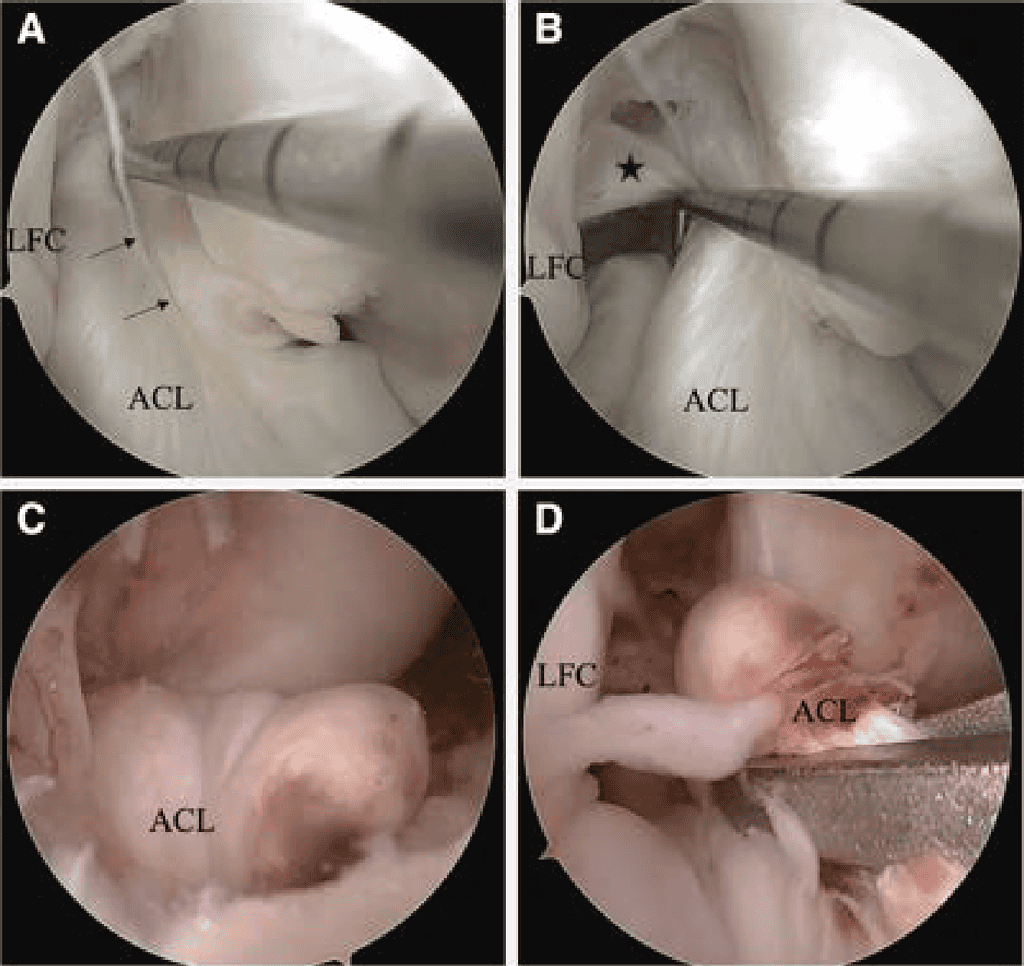 Arthroscopic View From The Anterolateral Portal Of The Right Knee