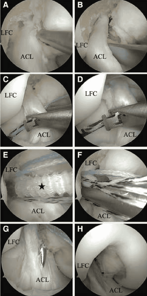 Arthroscopic View From The Anterolateral Portal Of The Right Knee