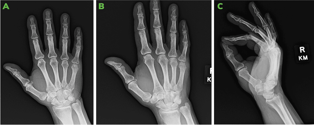 4-Weeks Post-Operative X-Rays: Ap [A], Oblique [B] And Lateral [C] Views.