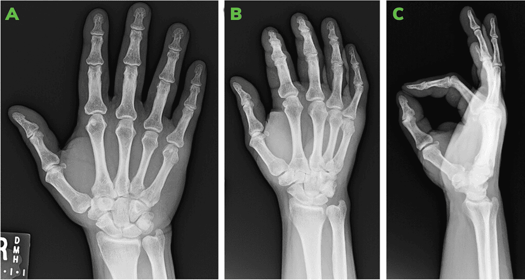 First Post-Operative X-Rays At 10 Days: Ap [A], Oblique [B] And Lateral [C].