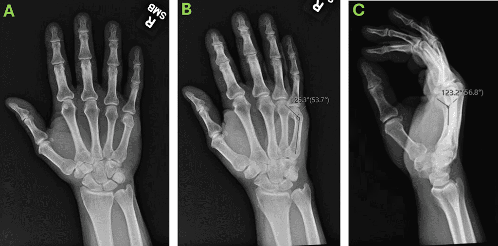 Pre-Operative X-Rays Showing 5Th Metacarpal Neck Fracture: Ap [A] Oblique [B] And Lateral [C]