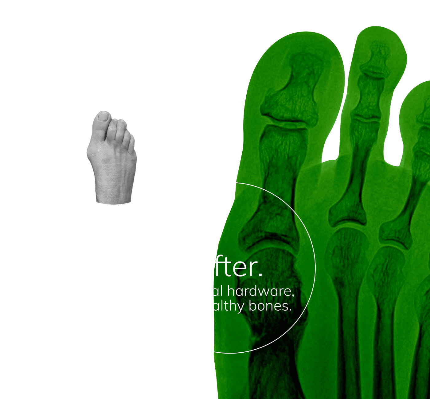 Bunion Mobile Ossio – Naturally Transformative Bone Healing