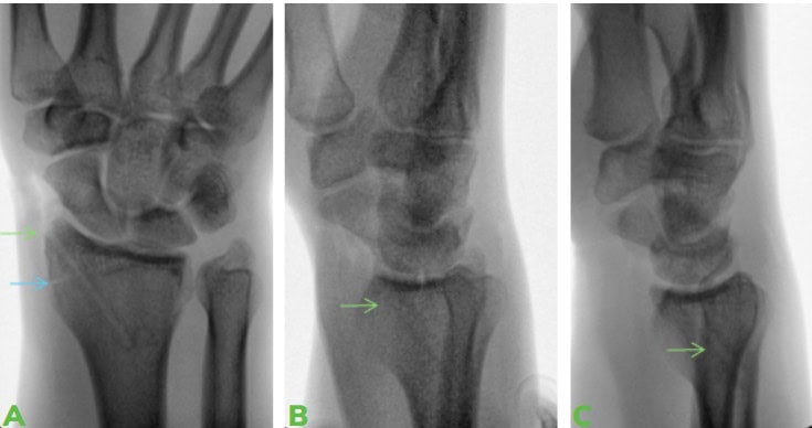 1 Image 1 Ossio – Naturally Transformative Bone Healing