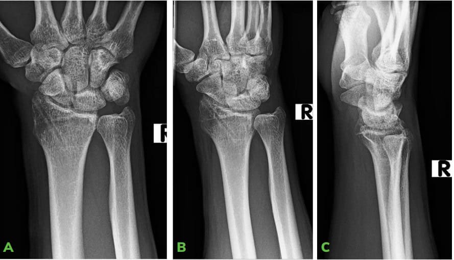 1 Image 3 Ossio – Naturally Transformative Bone Healing