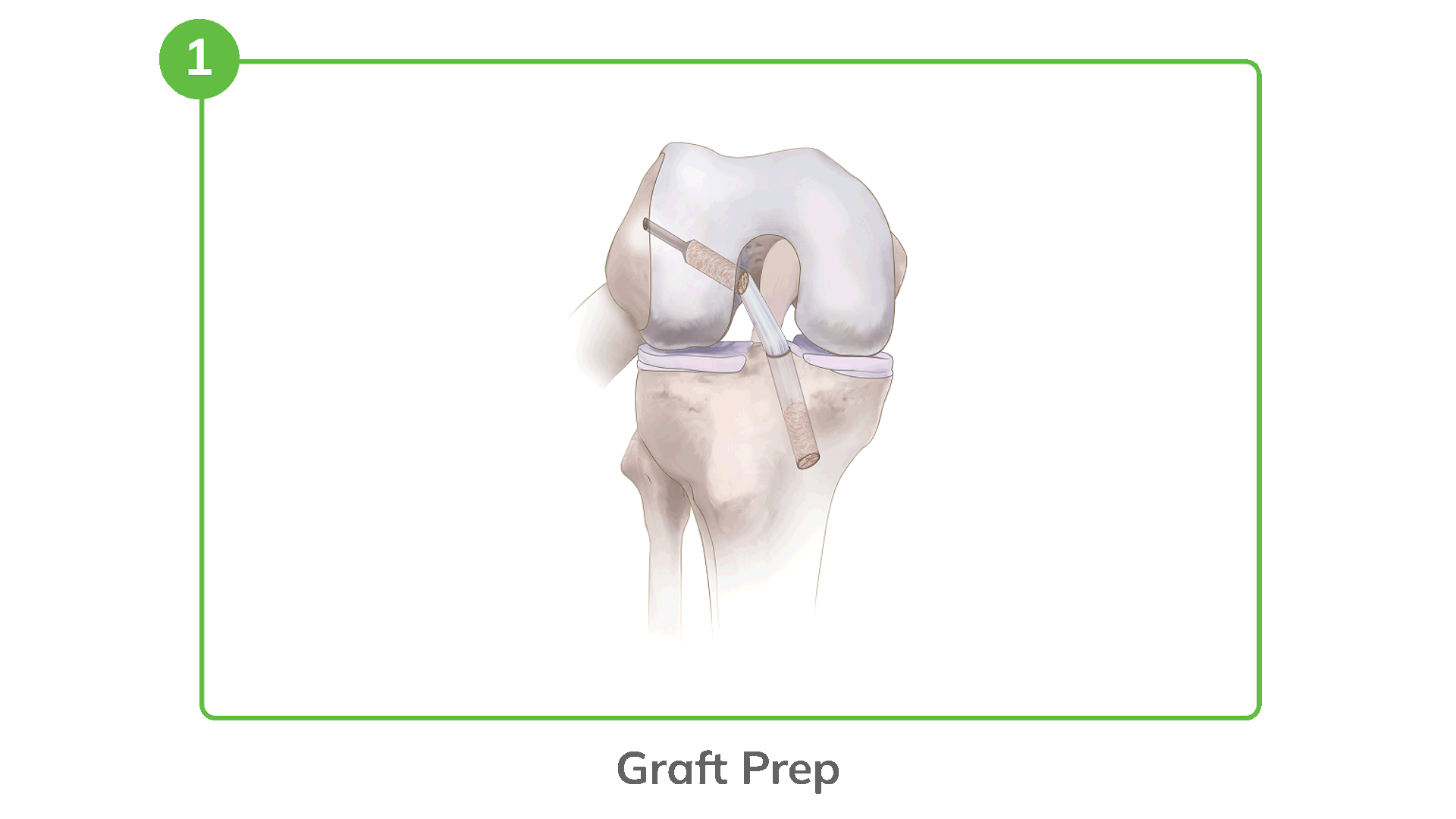 Ossio Reel V2 Ossio – Naturally Transformative Bone Healing